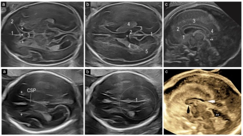 Lo que antes no veías: Cómo detectar agenesia parcial del cuerpo calloso en el screening básico con Voluson