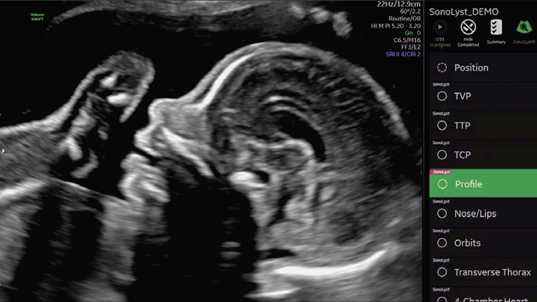 Cuerpo Calloso Fetal