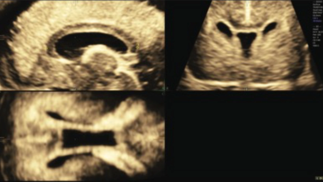 Cuerpo Calloso Fetal