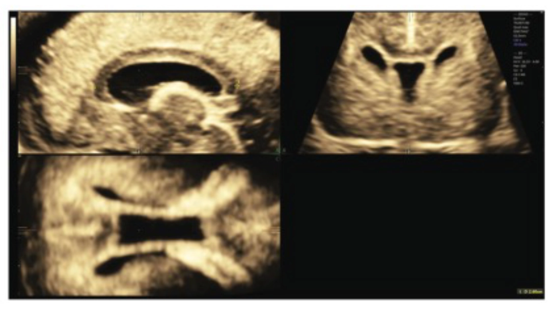 Plano Sagital Ecografia Transvaginal