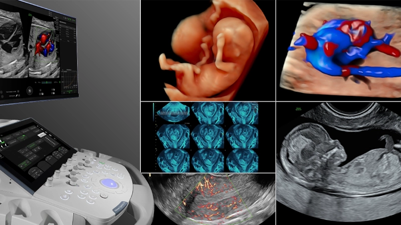 SonoLyst: reconocimiento de planos con IA en obstetricia